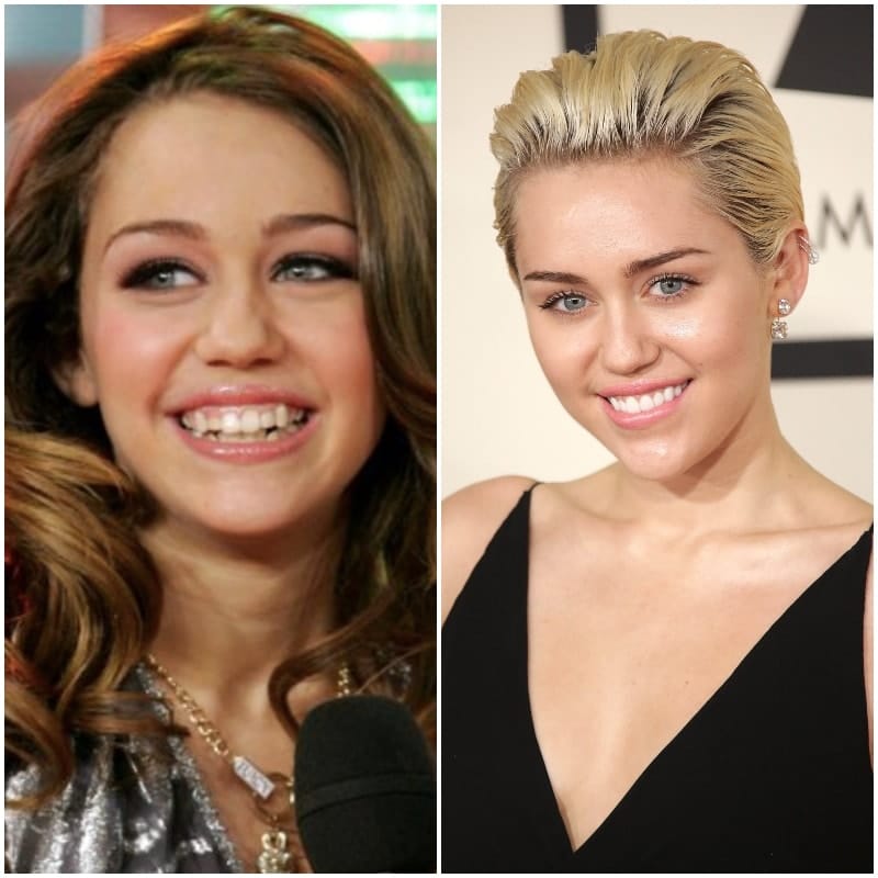 50+ Celebs Who Paid a Small Fortune on Dentalcare to Improve Their Smiles