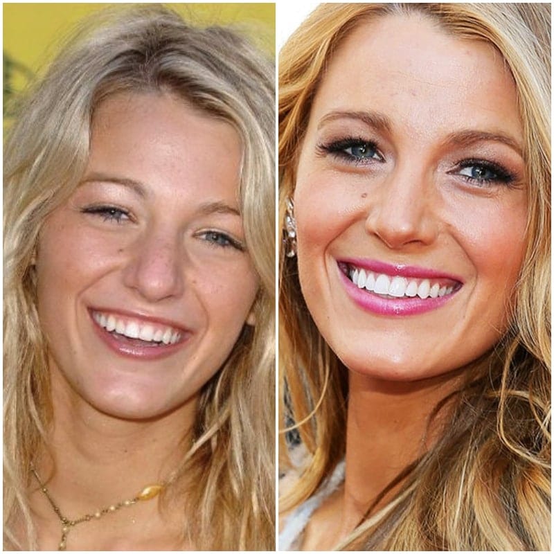 50+ Celebs Who Paid a Small Fortune on Dentalcare to Improve Their ...